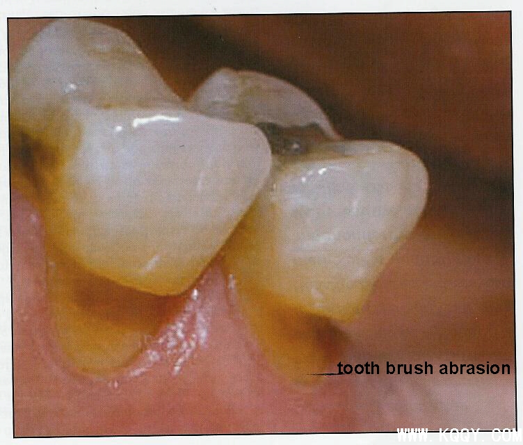 六种防龋制剂对牙釉质脱矿作用的研究