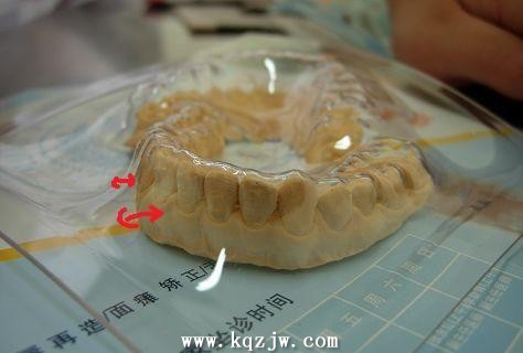 透明塑胶保持器制作失败后的模型处理和再制作