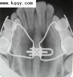 看图学正畸扩弓X光片