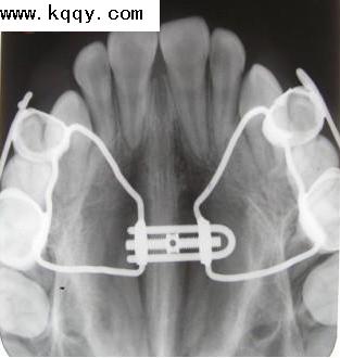 看图学正畸扩弓X光片