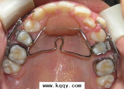 磨牙推进器颌内支抗带环的制作