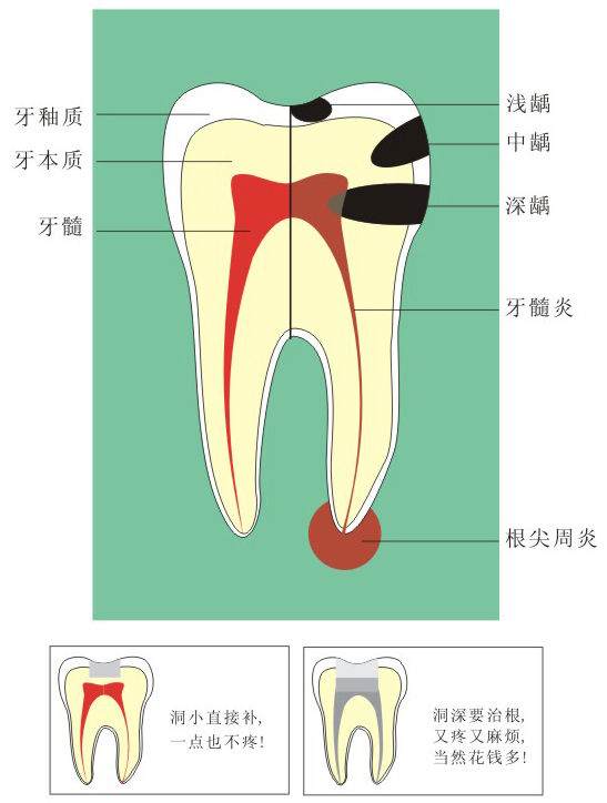 “杀”过神经的牙还会疼吗?