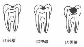 牙疼时为什么服用止疼药效果不好？