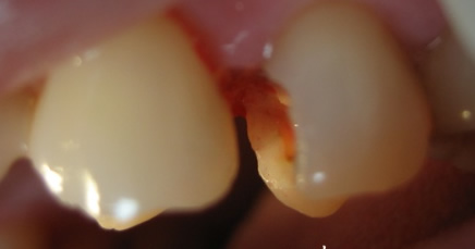 什么是牙龈切除术