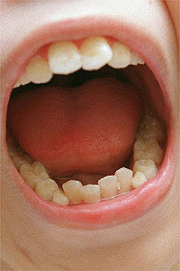 乳牙根尖周病的治疗有哪些特点