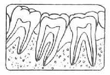 牙周脓肿的症状