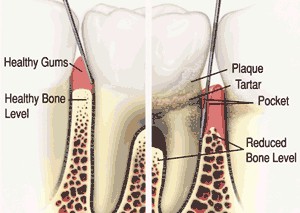 有牙周病的患者平时应注意哪些