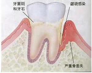 定期洁齿可以有效防牙周病