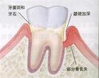 牙周病的病因