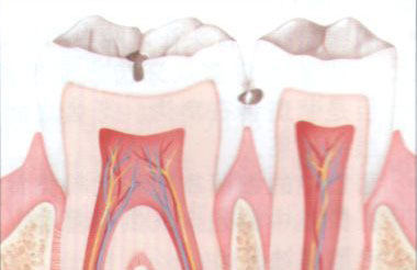 后牙咬合面黑点一定要治疗吗