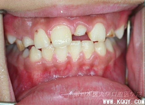 年轻恒中切牙根中1/3折断的拔出保存修复技术