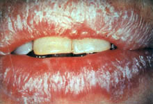 口腔粘膜病组织病理讲座---扁平苔藓