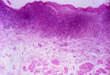 口腔粘膜病组织病理讲座---扁平苔藓