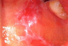 口腔粘膜病组织病理讲座---扁平苔藓