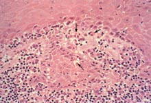 口腔粘膜病组织病理讲座---扁平苔藓