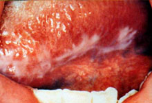 口腔粘膜病组织病理讲座---扁平苔藓