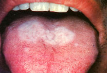 口腔粘膜病组织病理讲座---扁平苔藓