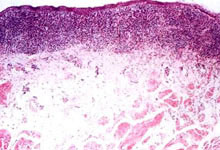 口腔粘膜病组织病理讲座---扁平苔藓