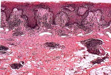 口腔粘膜病组织病理讲座---扁平苔藓
