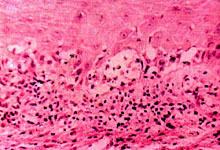 口腔粘膜病组织病理讲座---扁平苔藓