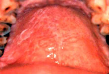 口腔粘膜病组织病理讲座---扁平苔藓