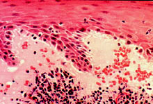 口腔粘膜病组织病理讲座---扁平苔藓