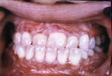 口腔粘膜病组织病理讲座---扁平苔藓