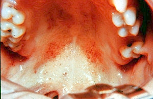 口腔黏膜的瘀点瘀斑