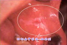 口腔粘膜病组织病理讲座---扁平苔藓