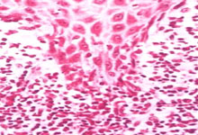 口腔粘膜病组织病理讲座---扁平苔藓