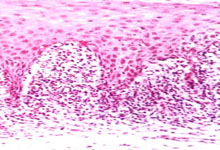 口腔粘膜病组织病理讲座---扁平苔藓