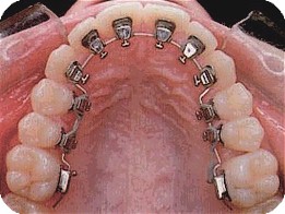Invisible Orthodontics - Lingual Braces