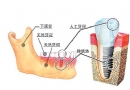 种植牙示意图
