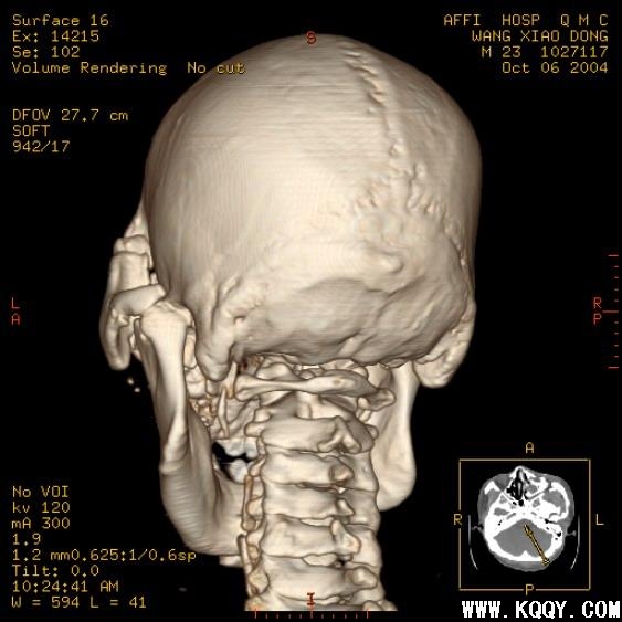 复杂颌骨骨折错位CT图