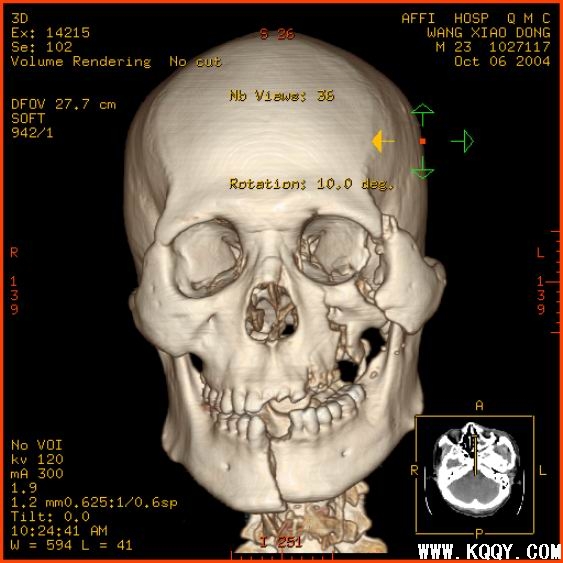 复杂颌骨骨折错位CT图