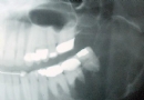 口腔癌X光影像