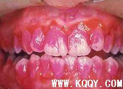 牙周护理六要素之六——菌斑显示剂与菌斑控制记录卡