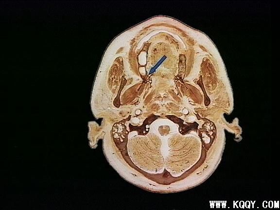 硬腭之 腭大孔