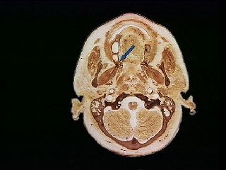 硬腭之 腭大孔