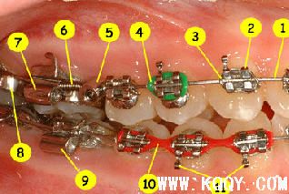 教你认识牙齿矫正器——固定矫治装置