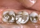 蛀牙补牙方法——银汞合金充填