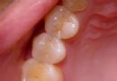 蛀牙充填方法——光固化树脂