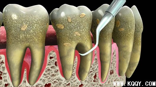 牙周炎的治疗方法——洁治术