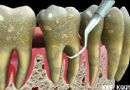 牙周炎的治疗方法——洁治术
