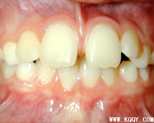 牙齿矫正病例——牙间小缝隙