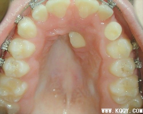 牙齿矫正图片——牙位异常