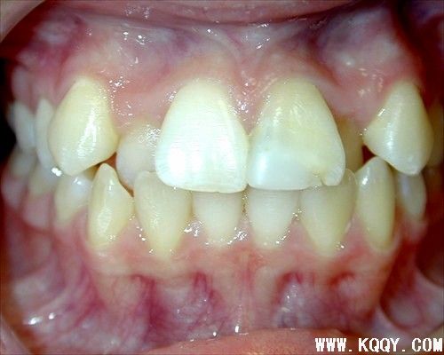 牙齿矫正病例图片——牙列拥挤