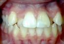 牙齿矫正病例图片——牙列拥挤