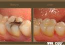 磨牙光固化树脂修复病例图片