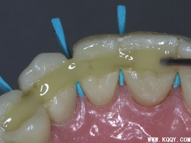 齿科超强纤维应用——牙周夹板